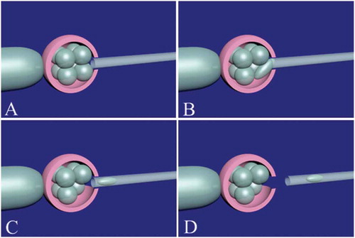 Figure 4. Blastomere biopsy in a cleavage-stage embryo. The embryo should be immobilized by the holding pipette. Noncontact 1.48 diode laser is used for zona pellucida opening (A). It is important to open the zona pellucida near the blastomere which is candidate for biopsy. After assisted zona hatching, the biopsy micropipette (inner diameter: 20–40 µm) is gently entered and brought in close proximity to the blastomere (B). The blastomere with visible nucleus is gently removed (C). The biopsy pipette is removed from the embryo (D). The biopsied blastomere is released to biopsy medium and the embryo is released from the holding pipette.