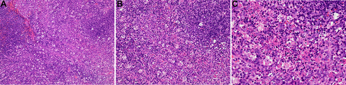 Figure 3 Hematoxylin and eosin stained section of the resected lymph node ((A) 100×; (B) 200×; (C) 400×).