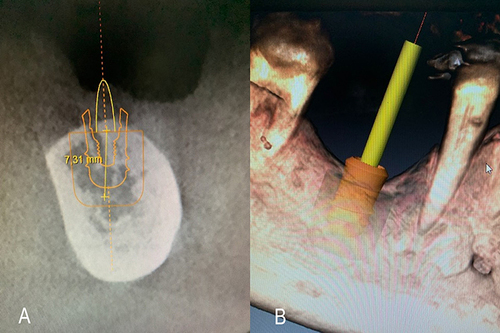 Figure 6 CBCT examination (A) and virtual planning for implant installation (B).