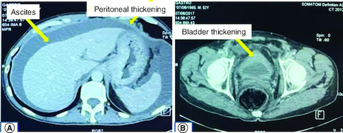 Figure 2. CT scan showing ascites, peritoneal and bladder parietal thickening.(A) Contrast enhanced CT scan demonstrating ascites and peritoneal thickening. (B) Contrast enhaced CT scan demonstrating bladder thickening.