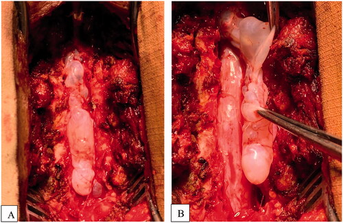 Figure 5. Per operative photograph demonstrates an extradural, large lobulated cystic lesion after laminectomy of D11-L2 (A) and complete excision of the cyst (B).
