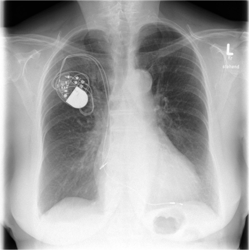 Figure 1 Chest X-ray after pacemaker implantation.