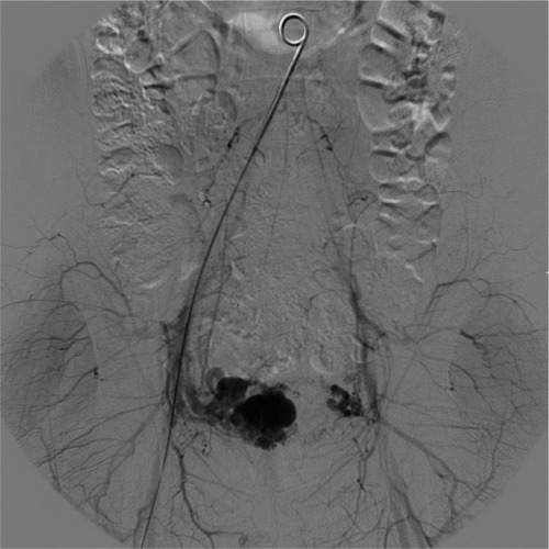Figure 3 Pelvic angiogram shows a bilateral superselective catheterization.