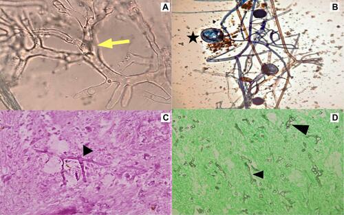 Figure 3 Microbiological and histopathological features of mucorales. (A) KOH mount showing broad aseptate hyphae (yellow arrow). (B) Lactophenol cotton blue mount showing aseptate hyphae with extension of columella into sporangium (star). (C) Periodic acid Schiff stain (400x) showing broad aseptate hyphae with right angle branching (black arrowhead). (D) Silver methenamine stain (400×) showing broad aseptate hyphae (black arrowhead) in necrotic tissue.