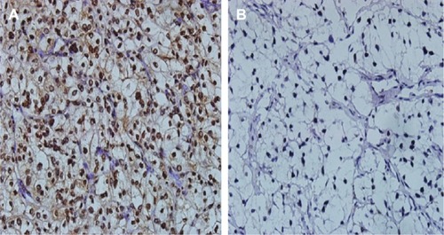 Figure 1 Representative images of immunoreactivity for HO-1 in tumor tissues.