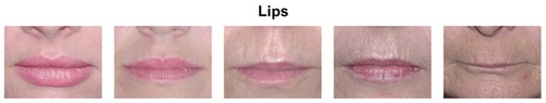 Figure 4 Region 4 (lower face) showing lip volume.