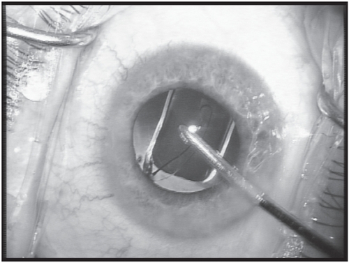 Figure 3 Placement of the IOL into the capsular bag under continuous irrigation.