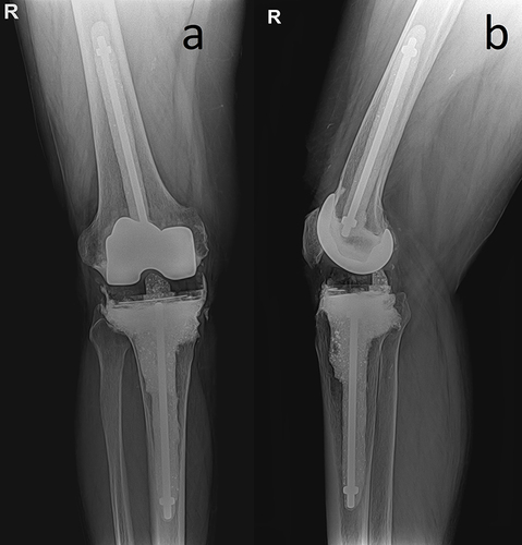 Figure 6 Radiography of the knee joint 48 months after surgery. (a) in the frontal plane; (b) in the sagittal plane.