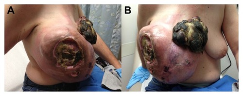 Figure 1 (A and B) Right chest wall mass measuring 29.5×26.0×14.0 cm that ulcerated the overlying skin and formed a fungating necrotic skin lesion.