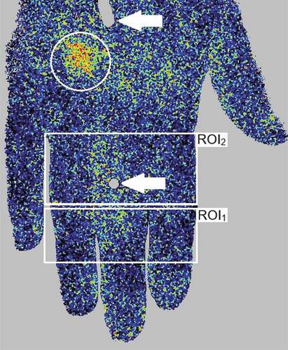 Figure 1. An example of laser speckle contrast analysis (LASCA) imaging of the dorsal surface of the right hand, depicting regions of interest (ROI) (white rectangles), a perfusion hot spot (white circle) indicating dyshomogeneous perfusion, as well as felt pen marks (white arrows) on the middle finger and the back of the hand, for positioning