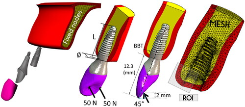Figure 1. Finite-element model descriptions: geometry (mm), mesh, boundary conditions (fixed nodes), and occlusal loading (N: newton). L: implant length, ∅: implant diameter, BBT: buccal bone thickness, ROI: region of interest (only the mesial ROI is visible in the image, but distal ROI was also used to calculate the peri-implant bone resorption risk indexes).