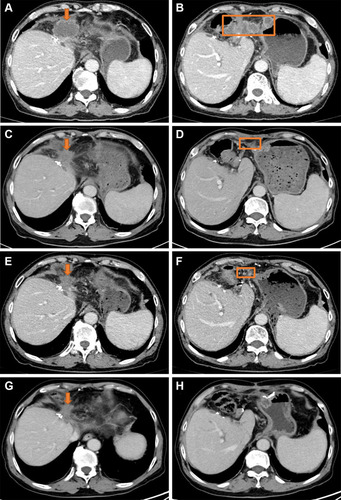 Figure 3 CT scan of case 2. The orange boxes represent local recurrence. The arrows represent abdominal lymph node and peritoneum metastasis. Baseline CT scan before immunotherapy: (A) and (B). CT scan after three cycles of sintilimumab treatment: (C) and (D). CT scan after six cycles of sintilimumab treatment: (E) and (F). CT scan after 12 cycles of sintilimumab treatment: (G) and (H).