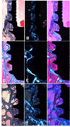 Figure 8 Polarization light microscopy. (A–C) HAnano® group; (D–F) SLActive® group, and (G–I) TiUnite® group. (A, D and G) bright filed microscopy; (B, E and H) Polarization light microscopy; (C, F and I) polarization light microscopy with compensator crystal (λ = 551 nm). The general orientation of bone collagen fibers is easily seen when using polarization light microscopy. Blue in the figure means that fibers are parallel to the higher refraction index of the compensator.