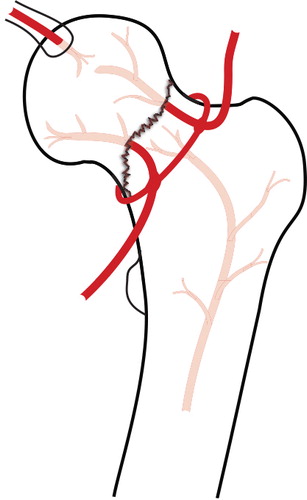 Figure 6. Schematic illustration of the blood supply to the femoral head