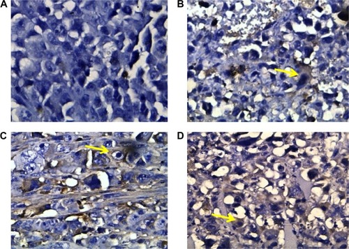 Figure 4 Caspase-3 expression in different groups of tumors.