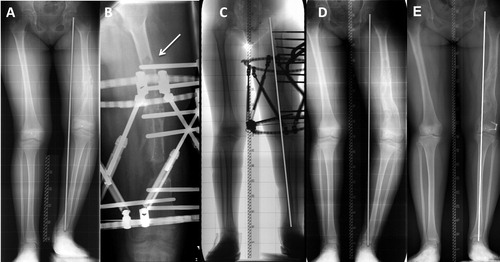 Figure 3. An 8-year-old girl with Ollier’s disease. The initial deformity included shortening and varus (panel A). The patient sustained a fracture during treatment (B) and was treated by extension of the frame. The other long standing radiographs were taken when lengthening was completed (C), after frame removal—with complete recurrence of varus deformity (D), and when this was solved by hemi-epiphysiodesis, with an acceptable result (E).