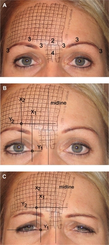 Figure 1 A) Pre-treatment patient with relaxed fronto-glabellar area and a removable 5 mm grid on the central and right frontal region. Numbers indicate the injection sites with corresponding number of BoNT/A units injected. B) Relaxed muscle tension. The point of interest 30 mm lateral to the midline, immediately above the eyebrow, was marked with two perpendicular black lines, coordinates (X2; Y2). The reference point of the geometric system at the inner canthus of the right eye was marked (X1; Y1) and subtracted from any point of interest for the purpose of calibration. C) Maximum fronto-glabellar contraction with otherwise identical markings as in Figure 1B. The horizontal movement of the point of interest from Figure 1B (relaxed) to Figure 1C (contraction) was calculated in pixels as ΔX = [(X2 contraction − X1) − (X2 relaxed − X1)].