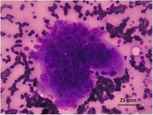 Figure 3 Very large multinucleated giant cell with 125 nuclei (Giemsa, x400).