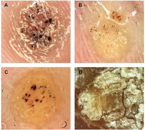 Figure 4 Different patterns of plantar warts under the dermoscope. (A) frogspawn pattern. (B) scaly yellowish structureless with bleeding streaks and spots, (C) yellow-gray structureless with bleeding streaks and spots, (D) raised papilliform scaly yellowish wart.