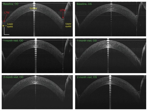 Figure 2 Tear menisci before and after 2 months of Restasis® treatment.