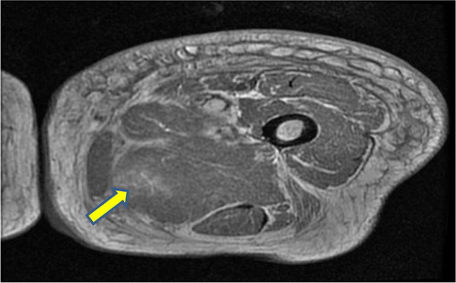 Fig. 1 T2-weighted cross-sectional MRI image of the left thigh showing edema and breakdown of muscle architecture.