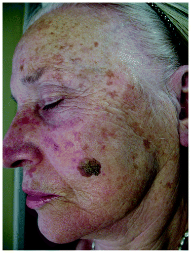 Figure 7. Multiple lentigines senilis on face of an elderly woman and a seborrheic keratosis on her left cheek.