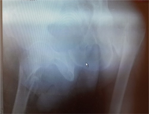Figure 2 Anteroposterior plain radiography of both hips showing bilateral intertrochanteric femur fractures.