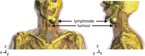 Figure 3. Transparent anatomy visualisation in SEMCAD X. Bone tissue, the tumour and the artificial lymph node metastasis are non-transparently visualised.