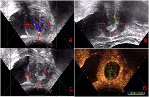 Figure 2. Ultrasound images obtained during HIFU treatment. A, pre-HIFU ultrasound image showed the fibroid's location and blood supply (red arrows); B, post-HIFU utrasound image showed grey scale changes in the fibroids (red arrows); C, post-HIFU utrasound image showed that the blood supply disappeared in the fibroids (red arrows); D, post-HIFU contrast ultrasound image showed no perfusion in the fibroids (marked with green lines).