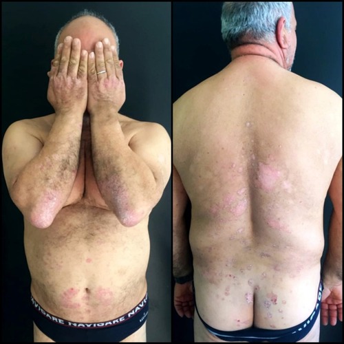 Figure 1 Patient psoriasis severity before treatment with Apremilast.