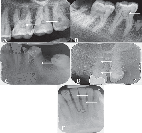Figure 2. Radiographic images showing pulp stone and pulp canal obliteration associated with different dental parameters.