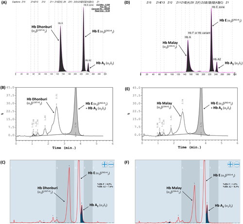 Figure 6. Hb analysis of Hb Malay (A-C) and Hb Dhonburi (D-F) using capillary electrophoresis (A&D), HPLC-VARIANT II (B&E), and HPLC-Premier resolution (C&F).