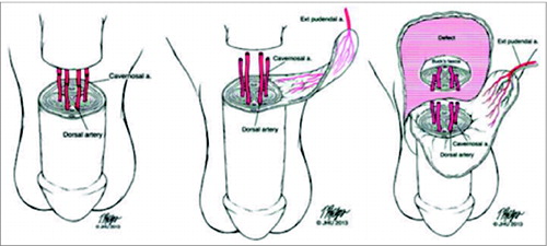 Figure 2. Recommended strategy for vascularizing penile allografts. (A) Mid or distal shaft transplant: DA and CA. (B) Proximal shaft: DA, CA and EPA with skin bridge. (C) Proximal shaft with surrounding defect: DA, CA, and EPA with additional skin to resurface defect.