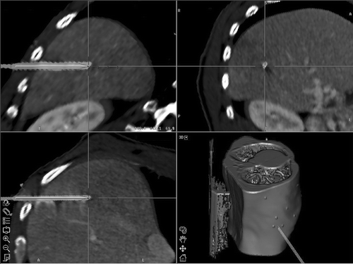 Figure 1. Screenshot of the native control CT data with the needles in place fused with the contrast-enhanced planning CT data showing the planned trajectory as well as the inserted coaxial needle. The upper and lower left images correspond to longitudinal cuts along the planned trajectory (“trajectory views”). The upper right image shows an orthogonal cut at the tip of the coaxial needle (the “probe's eye view”), and the lower right image is a 3D rendering of the trajectory and the patient.