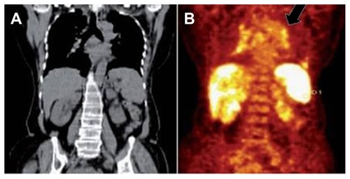 Figure 4 Coronal plain computed tomography (A) and positron-emission tomography (B) images showing diffuse increased 18F fluorodeoxyglucose uptake in spleen and multifocal uptake in liver, mediastinal node (black arrow).