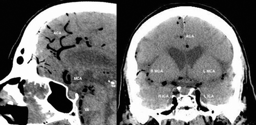 Figure 4. Sagittal and coronal CT head: abnormal intra-arterial gas seen within internal carotid arteries (ICA), vertebral artery (VA) and intra-cranial arteries. Air embolus is seen in bilateral peri-callosal anterior cerebral arteries (ACA) and bilateral middle cerebral arteries (MCA) (R = right; L = left).