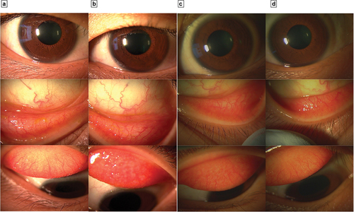 Figure 1. a: Right eye at first visit in September 2021, b: Left eye at first visit in September 2021, c: Right eye at the second week after ARCL application, d: Left eye at the second week after ARCL application. a and b: Case four’s right and left eyes during the first admission, after which the patient was diagnosed with VKC. Subsequently, She was instructed to strictly adhere to the frequency and interval of topical tacrolimus steroid drops and started ARCL two months after. c and d: Right and left eyes two weeks after starting ARCL. Symptoms and objective findings became better without topical treatment and with CL refraction correction.