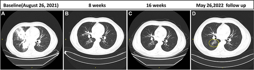 Figure 3 Representative clinical images before and after crizotinib treatment. (A–D) Comparison of primary lesions on baseline and every 8 weeks.