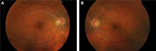 Figure 4 Follow-up examination at 6 months after the acute phase.