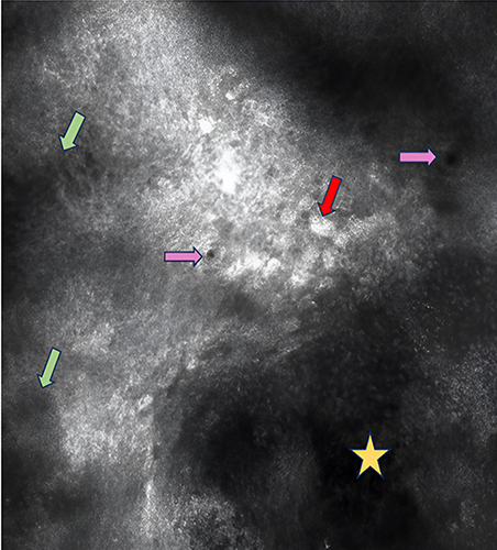 Figure 2 Reflectance confocal microscopy (RCM) image at the depth of stratum spinosum. Eccrine glands ducts openings (pink arrow); vesicle with increased cellularity (yellow star); spongiosis and disrupted honeycomb pattern (green arrows), enlarged, bright keratinocytes in the periphery of the vesicle (red arrow).