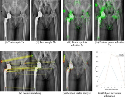 Figure 8. (i–vii) Hip replacement surgery with bone position deviation: (i) Test sample 2a (ii) Test sample 2b (iii) Feature points selection 2a (iv) Feature points selection 2b (v) Feature matching (vi) Motion vector analysis (vii) Object deviation estimation.