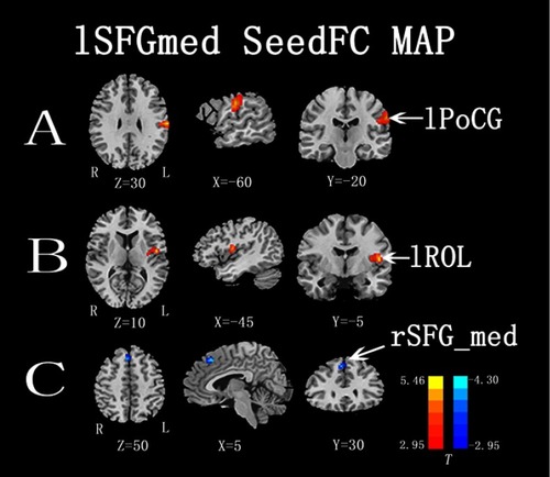 Figure 3  Functional connectivity differences between the two groups, lSFGmed selected as seed ROI (P<0.01, cluster-wise FDR corrected). Red-yellow spots, CSM>HC; blue spots, CSM<HC.