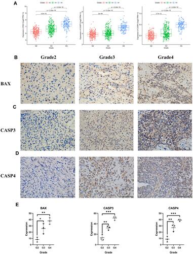 Figure 10 The expression of BAX and CASP3 and CASP4 in different grades of gliomas. (A) The expression of the three pyroptosis genes in glioma patients with different grades in the TCGA cohort. (B)–(D) The protein expression level of BAX and CASP3 and CASP4 in the glioma tissues with grades 2, 3, 4 by immunohistochemistry assay (E), *** represented p < 0.001, ** represented p <0.01 and * represented p <0.05).