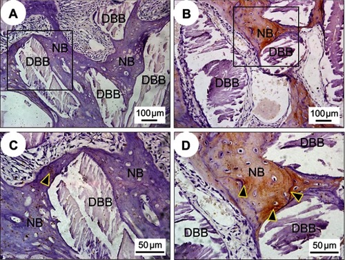Figure 7 Immunohistochemical evaluation of bone regeneration at 12 weeks post-implantation. Representative immunohistochemical staining images for detection of OCN expression in DBB granules around nascent bone tissues covered with PTFE membranes (A) or BTO/P(VDF-TrFE) nanocomposite membranes (B). (C) and (D) are enlargements of specific regions of (A) and (B) respectively. Black arrowheads denote the positive expression of OCN. Scale bars =100 μm for (A–B); Scale bars =50 μm for (C-D).Abbreviations: OCN, osteocalcin; DBB, deproteinized bovine bone; NB, nascent bone; PTFE, polytetrafluoroethylene; BTO, BaTiO3; P(VDF-TrFE), poly(vinylidene fluoridetrifluoroethylene).