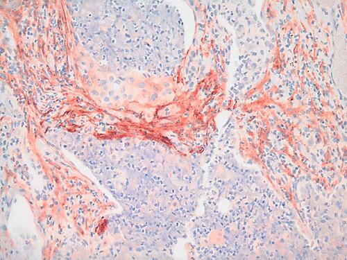 Figure 1 FAP expression in cancer tissue. Strong FAP expression (red) is observed in the stromal cells (CAFs) of a human squamous cell carcinoma stained with anti-FAP rabbit polyclonal antibody (dilution 1:100) IHC (20X image).