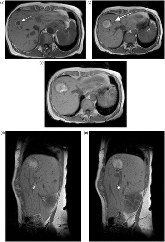 Figure 1. T1 weighted MRI of a 69-year-old woman showing metastasis of a primary breast carcinoma in liver segment 8 (arrow) measuring 14.1 mm prior to microwave ablation (a). After microwave ablation with ECSEC for 10 min with a cumulative output energy of 52,800 J, an almost ideal spherical ablation zone (deviation from 1.0 for ideal sphericity was 0.065) was detected 24 h post ablation in consecutive T1 weighted unenhanced transverse (b,c) and sagittal (d,e) MR images. Two consecutive slices per plane are shown for a better demonstration of the spherical ablation zone.