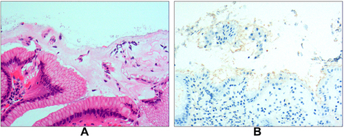 Figure 2 Stage I, the mucus layer infection stage: (A) Helicobacter pylori (Hp) colonizes in the mucous layer covered by the epithelium on the surface of the gastric mucosa (hematoxylin and eosin staining, ×400); (B) the result for Hp is positive (EnVision method, × 400).