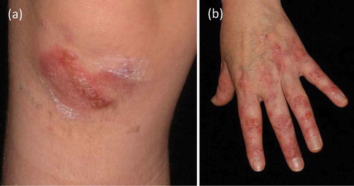 Figure 3. Classical variant of EBA. (a) Erythema and tense blisters on the right knee of a 6-year old boy. B. Erythema and erosions on the left hand of a 53-year old female.