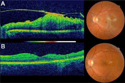 Figure 2 Spectral domain optical coherence tomography B-scan images before (A) and 2 months after surgery (B).