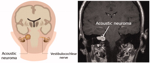 Figure 1. Scheme showing acoustic neuroma on the auditory nerve. (www.healthdirect.gov.au/acoustic-neuroma).